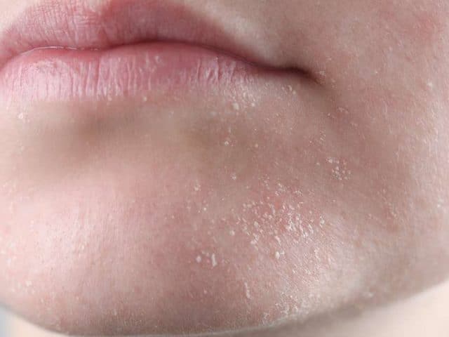 Pelle secca e pruriginosa per gli Over 60